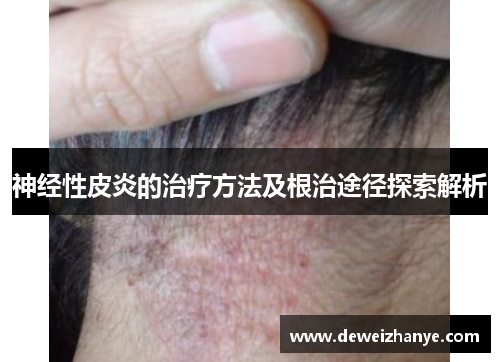 神经性皮炎的治疗方法及根治途径探索解析 神经性皮炎的治疗方法及根治途径探索解析